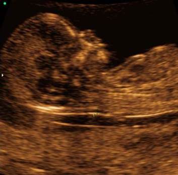 Normal nuchal translucency