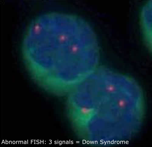 Abnormal FISH: 3 signals = Down Syndrome