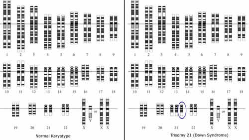 Picture of a normal karyotype (left) and Down syndrome karyotype (right)